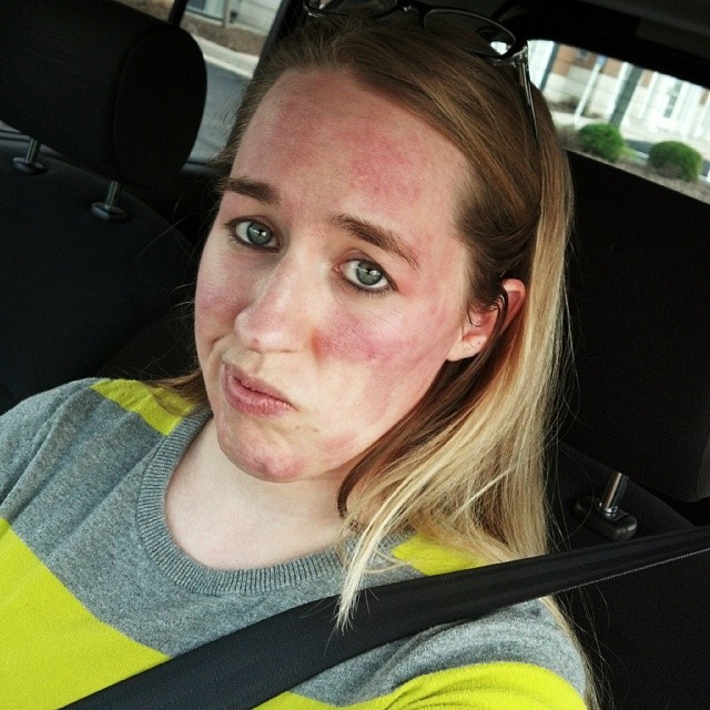 140408 Proactiv Reaction